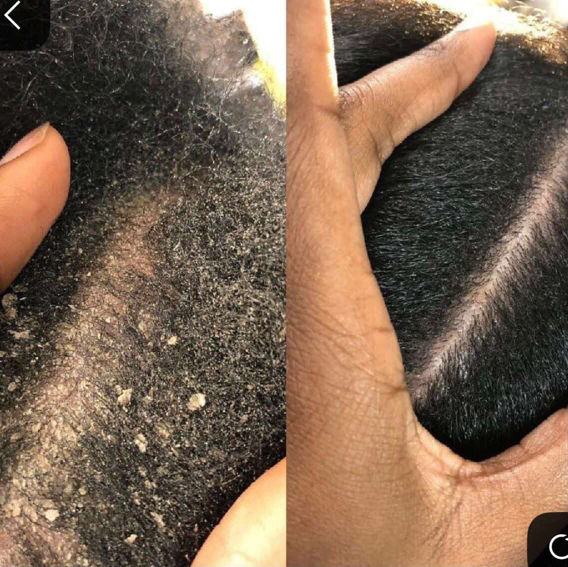 Scalp Reset: From Buildup to Balance