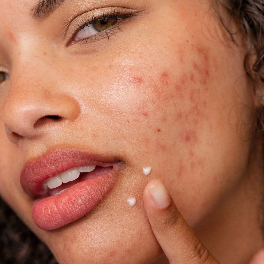 What Is Acne & How to Treat It: A Clear Guide