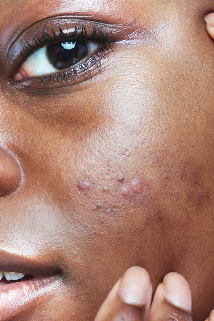 How to Treat Acne Without Damaging Your Skin